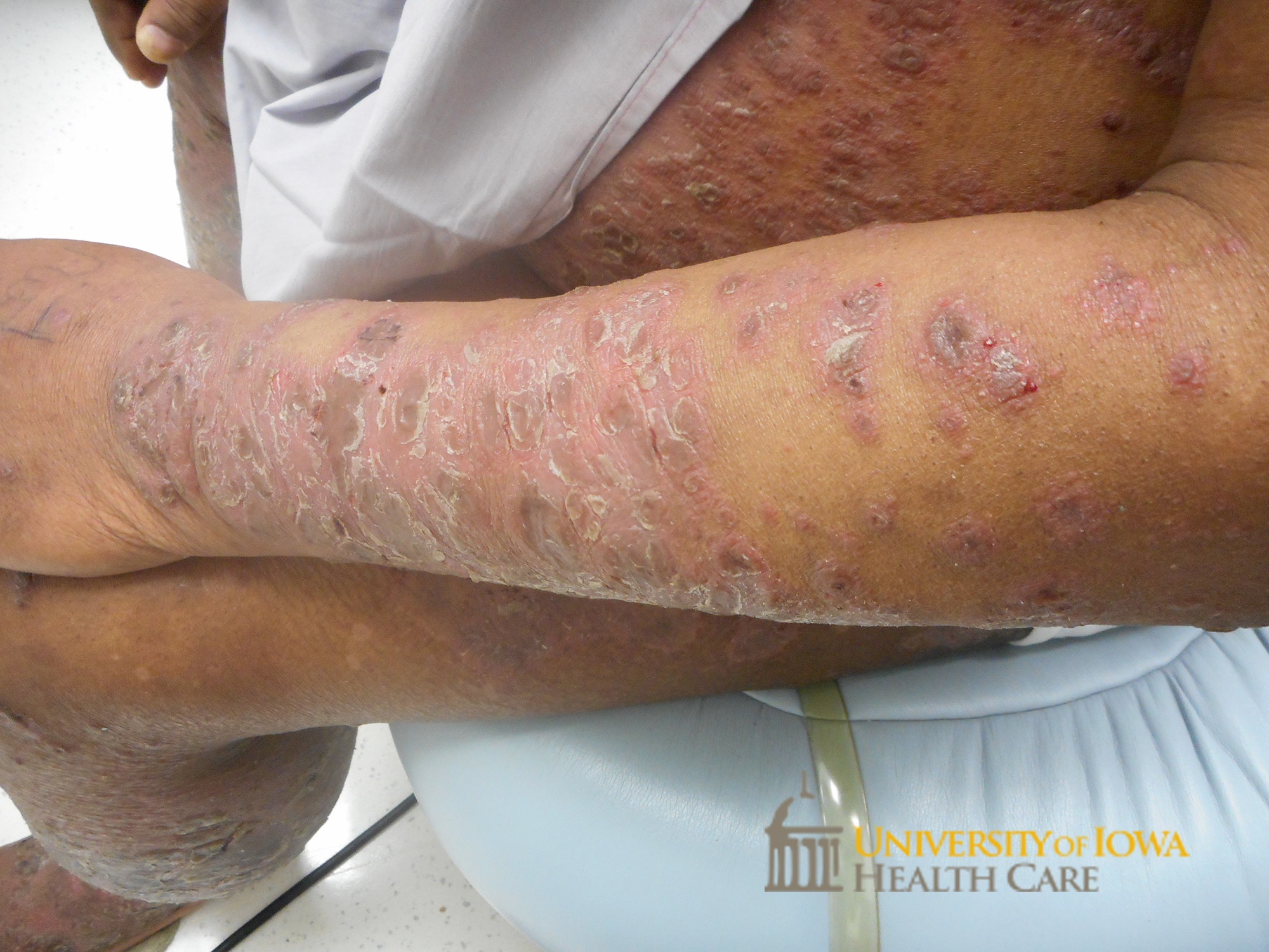 Pink to brown coalescing papules and plaques with thick overlying scale on the trunk and extremities. (click images for higher resolution).